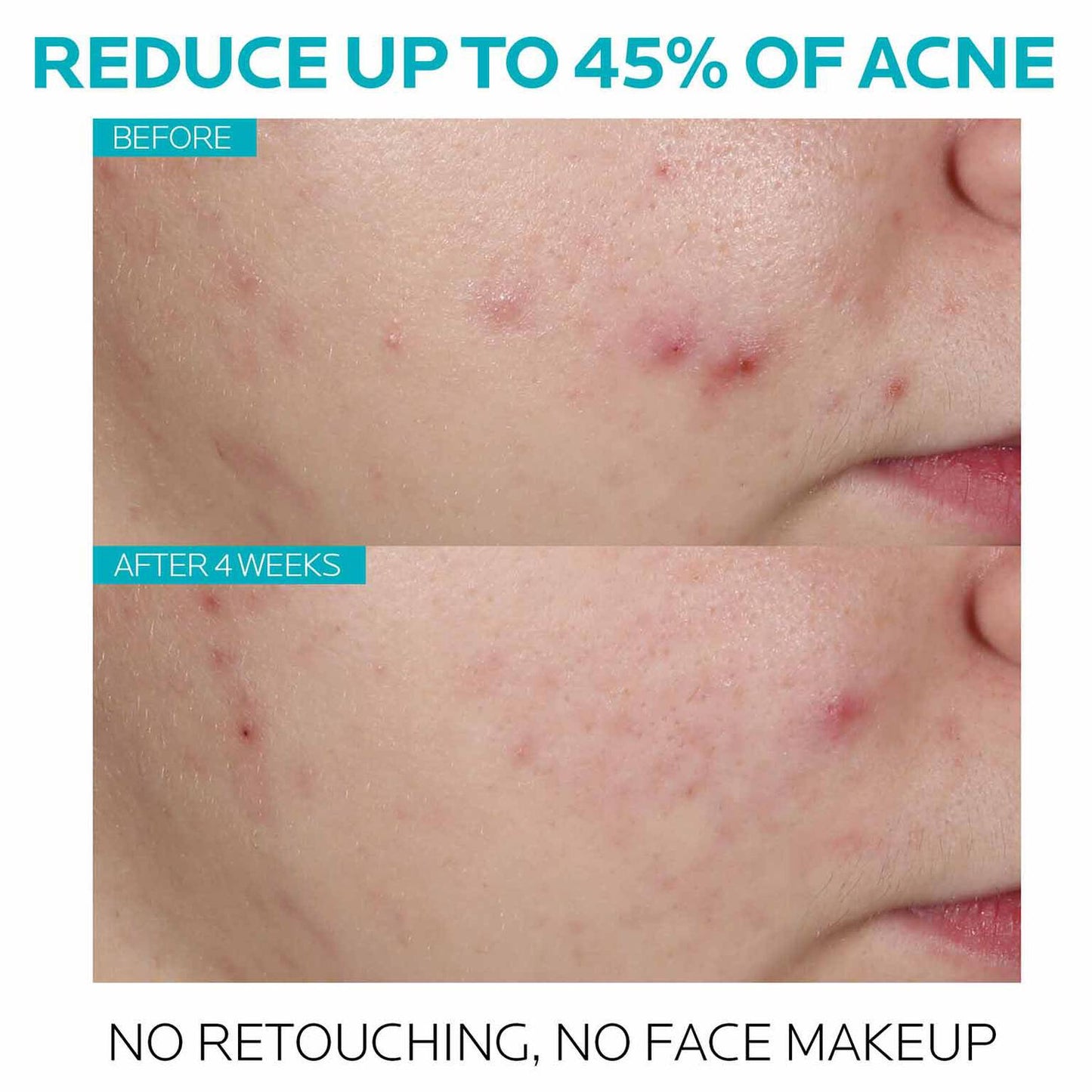 effaclar-salicylic-acid-acne-treatment-serum-q0 7_EffaclarSerum_After-45-days.jpg