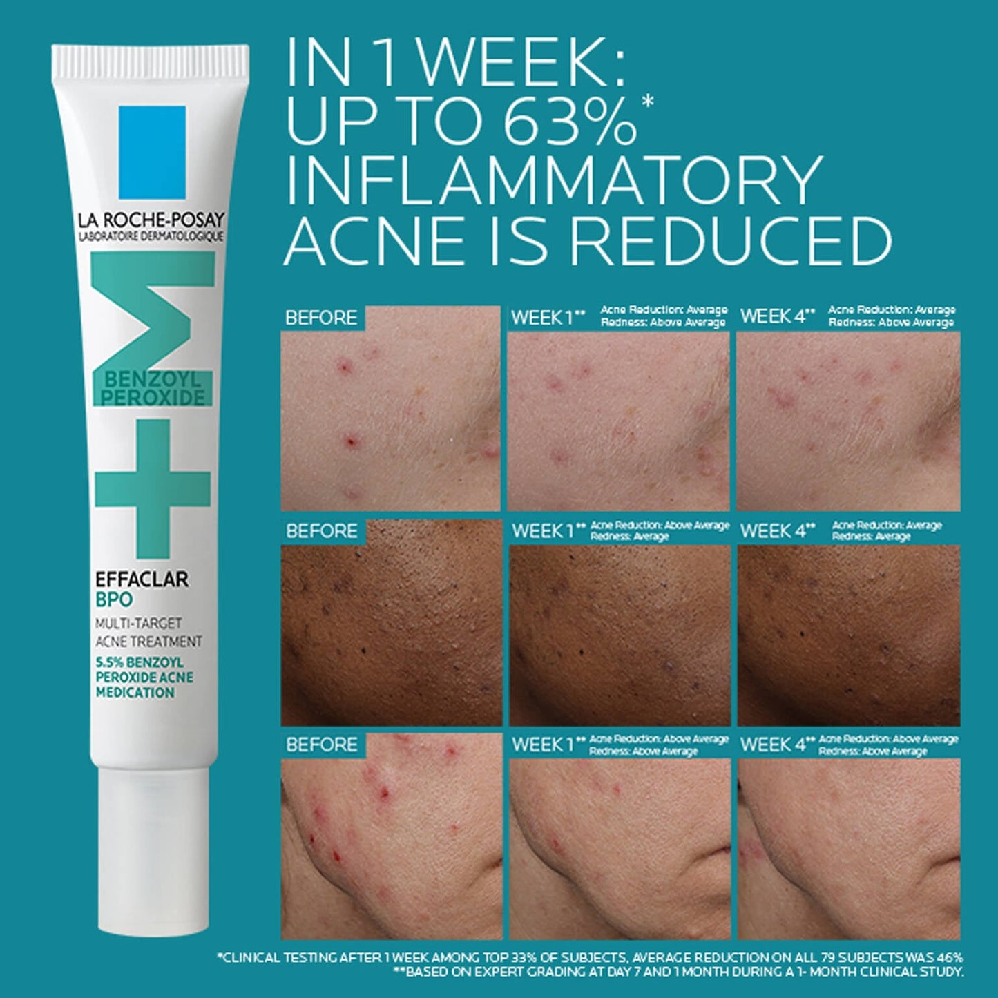 effaclar-bpo-multi-target-acne-treatment-with-5-5-benzoyl-peroxide-h7 EffaclarBPO-ClinicalBA-ATF-1500x1500-2.jpg