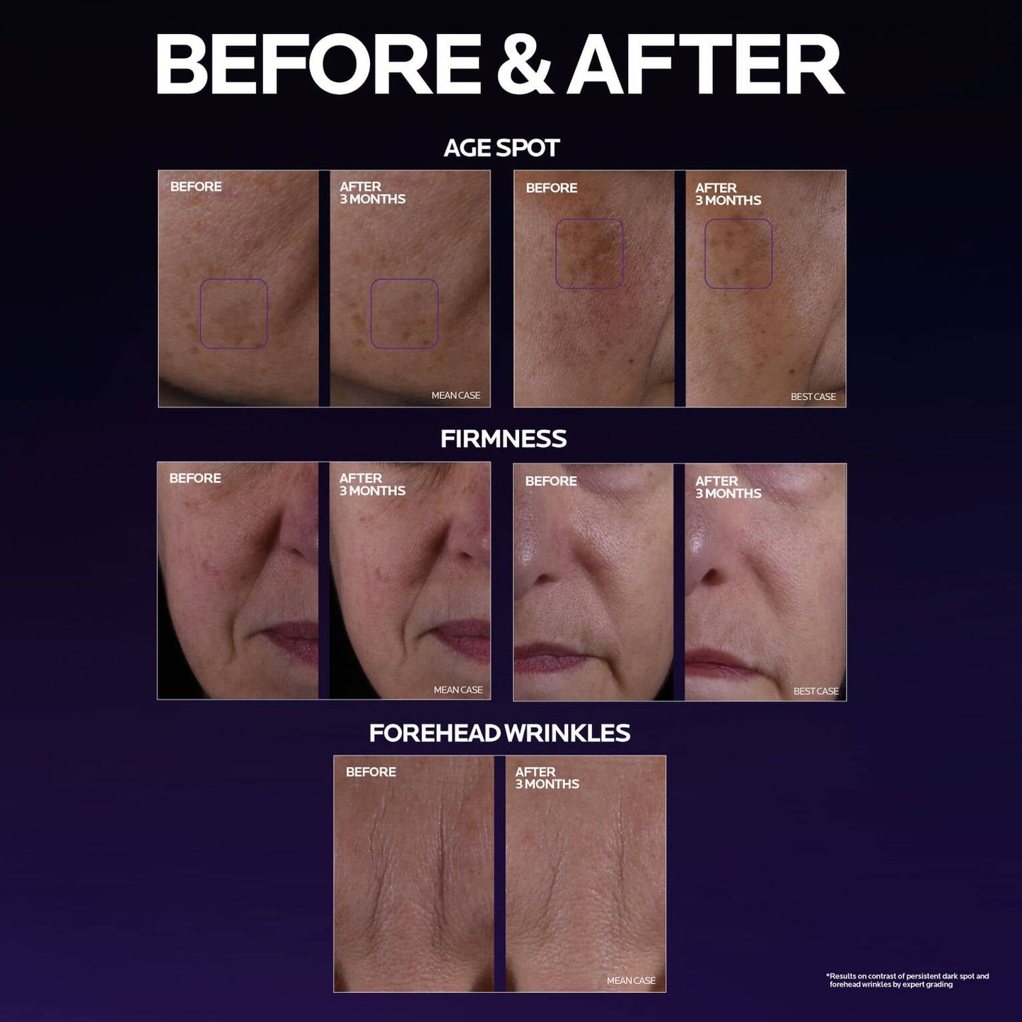 mela-b3-double-dose-discoloration-treatment-with-melasyltm-i3 MelaB3_DD_BTF_BeforeAfter_1500x1500_5.jpg