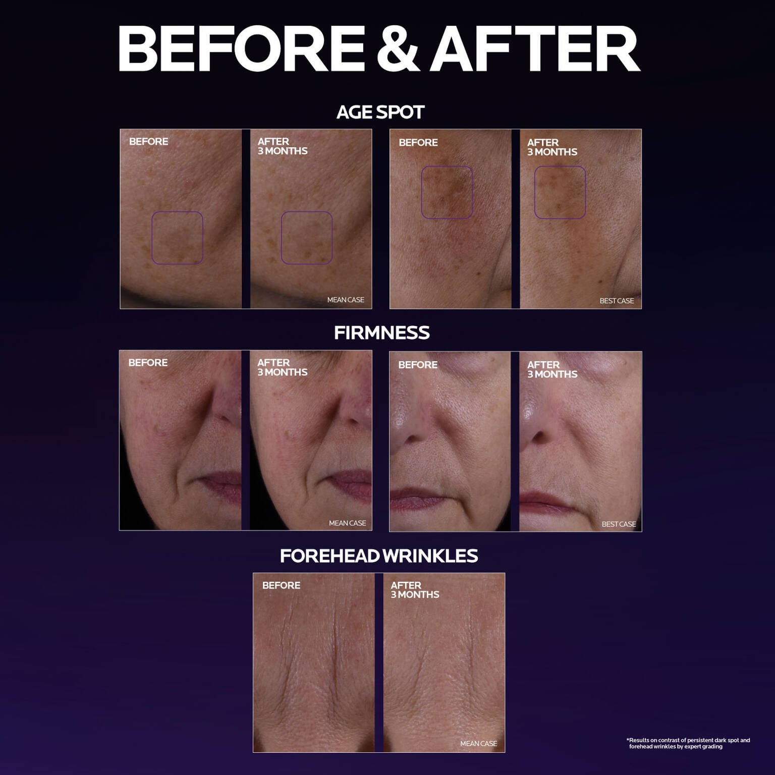 mela-b3-double-dose-discoloration-treatment-with-melasyltm-i3 MelaB3_DD_BTF_BeforeAfter_1500x1500_5.jpg